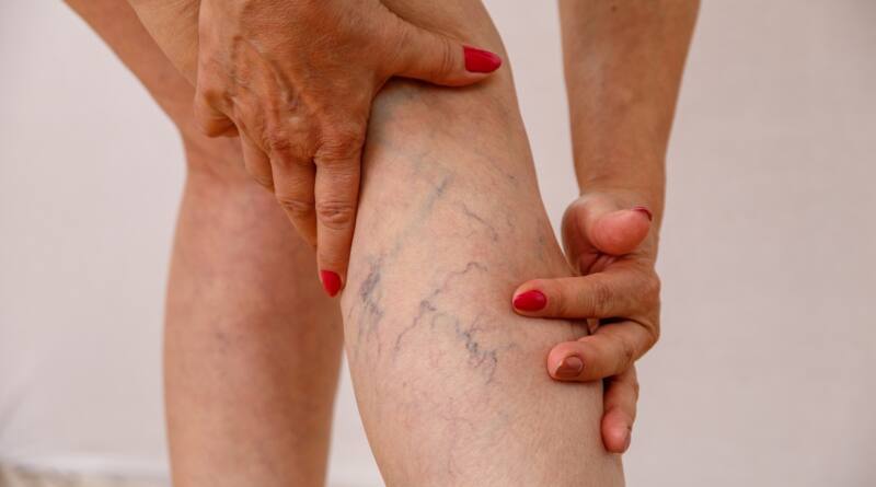 Varicose Veins, Cure And Care: Know It All Now