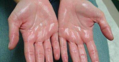 Hyperhidrosis: Amazing Way To Overcome A Rare Sweat Disorder