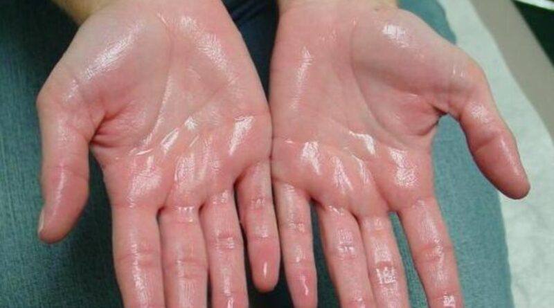 Hyperhidrosis: Amazing Way To Overcome A Rare Sweat Disorder