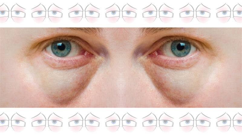 Make Tired Puffy Eyes Look Better: Know It All Now