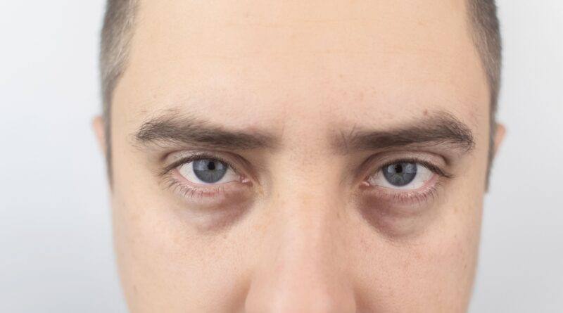 Better Eye Care To Overcome Bags And Dark Circles