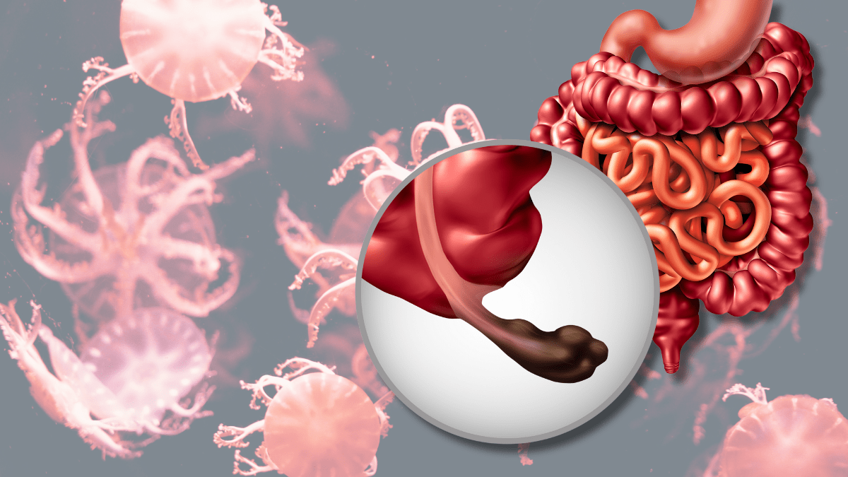 Spotlight – Colon Cancer: Know It All Here