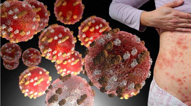 Measles Returns: The Truth We Need To Know Now